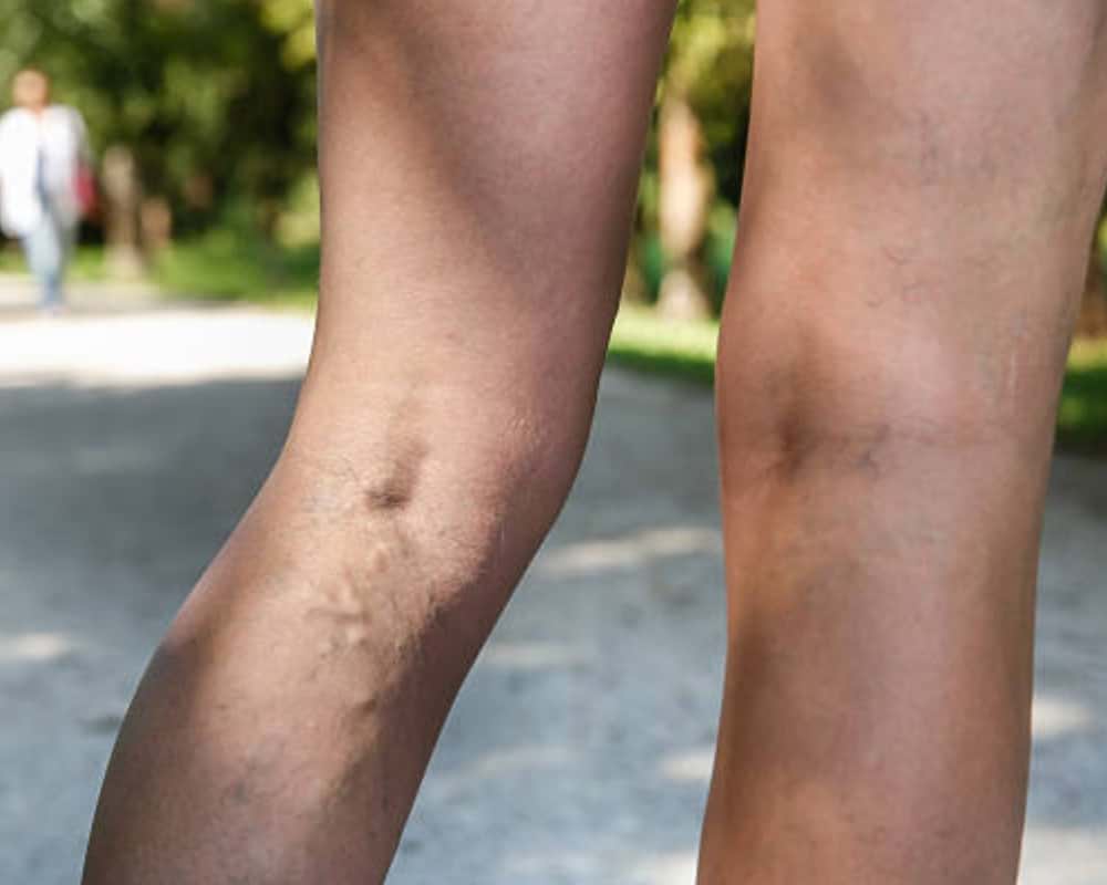 Varicose Veins Signs and Symptoms That It’s Time for a Surgical